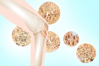 Natural Solutions for Preventing and Treating Bone Disease: A Guide to Osteoporosis Management